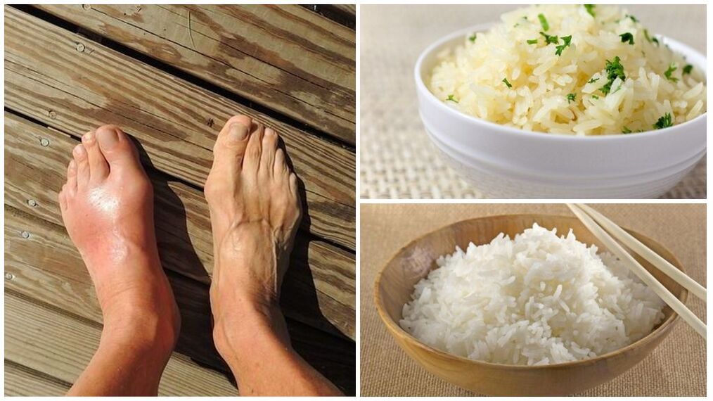 Patients with gout are recommended a diet made of rice. 